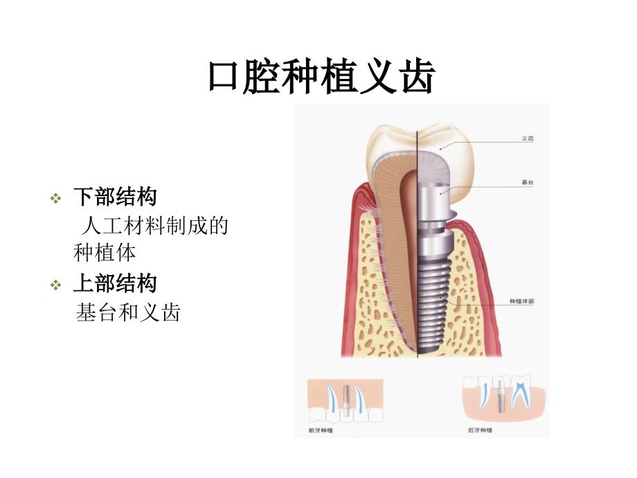 口腔种植体修复讲解_第2页