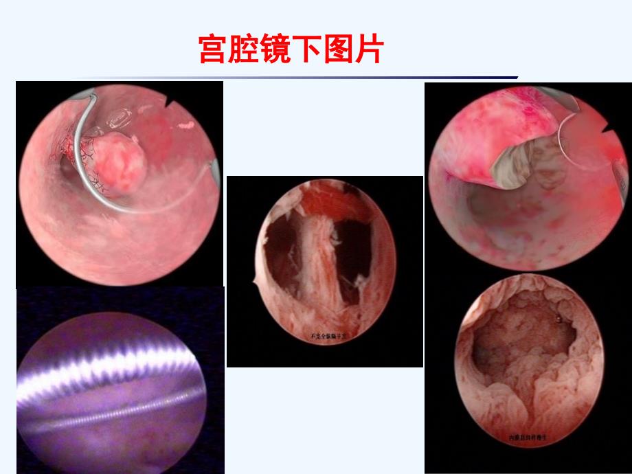 宫腔镜手术的护理_第4页