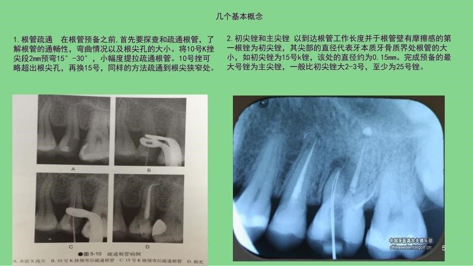 根管预备ppt课件_第5页