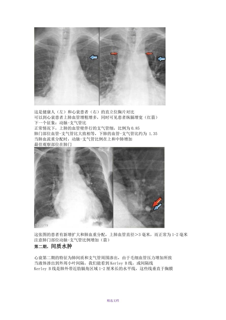 心衰的胸部X线征象_第3页