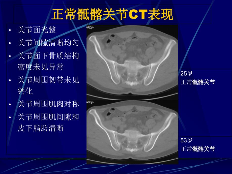 AS骶髂关节病变的CT诊断文档资料_第2页