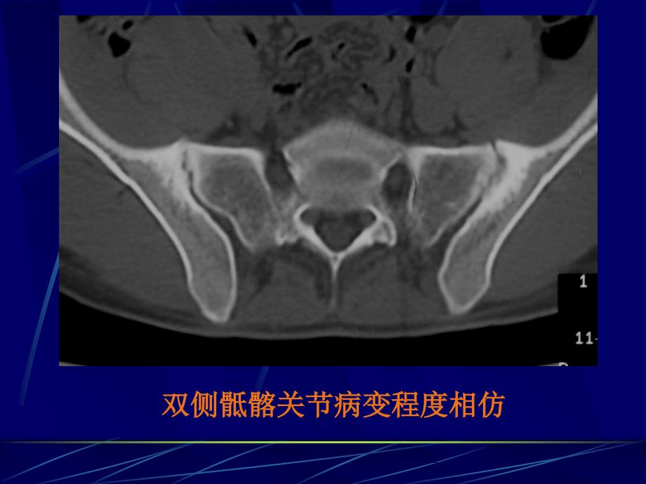 AS骶髂关节病变的CT诊断文档资料_第4页