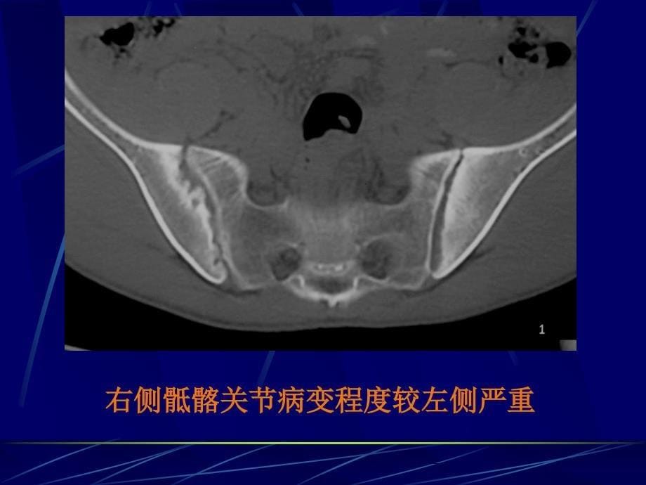 AS骶髂关节病变的CT诊断文档资料_第5页