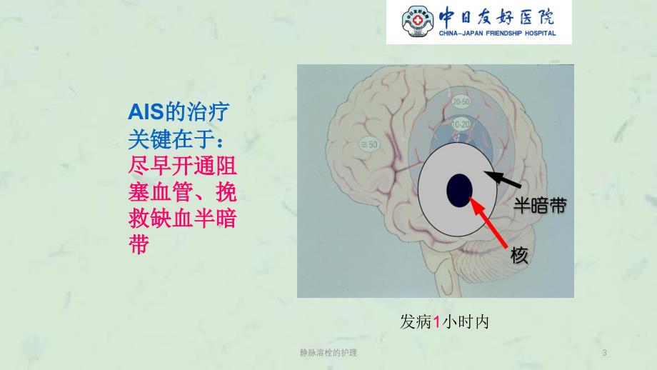 静脉溶栓的护理课件_第3页