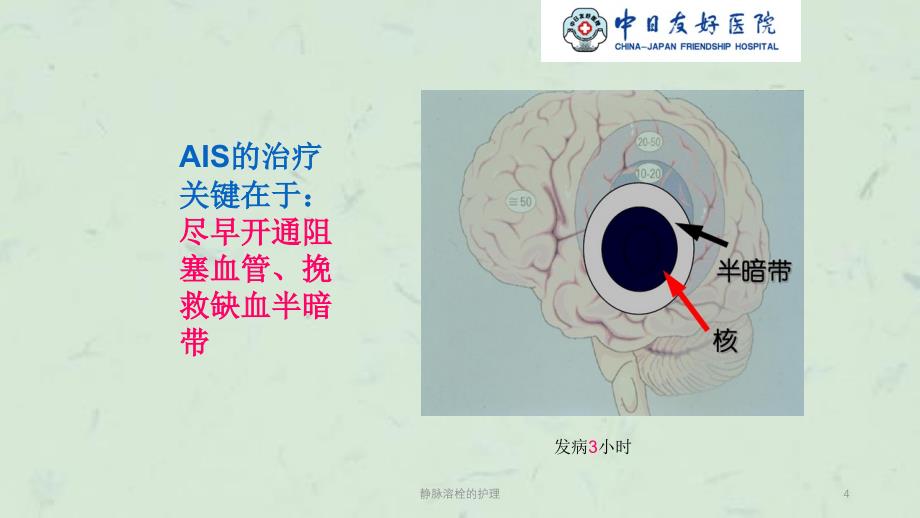 静脉溶栓的护理课件_第4页