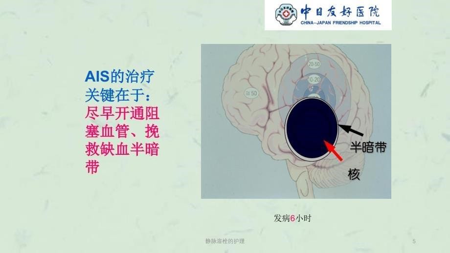 静脉溶栓的护理课件_第5页