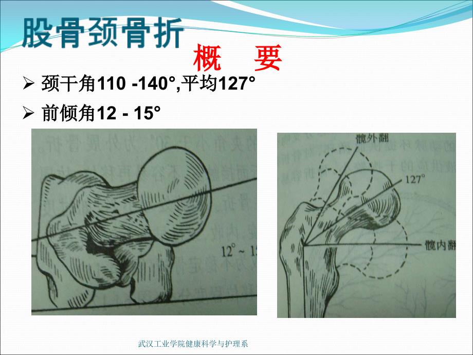 股骨颈骨折的康复_第2页