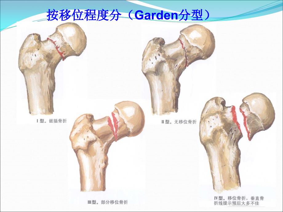 股骨颈骨折的康复_第4页