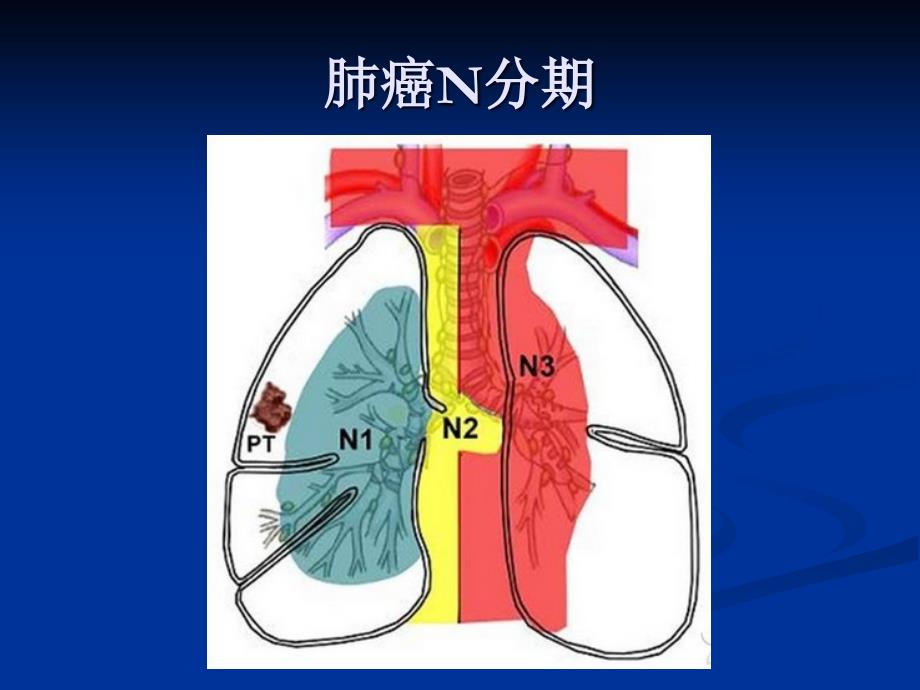 肺癌淋巴结分组PPT_第3页