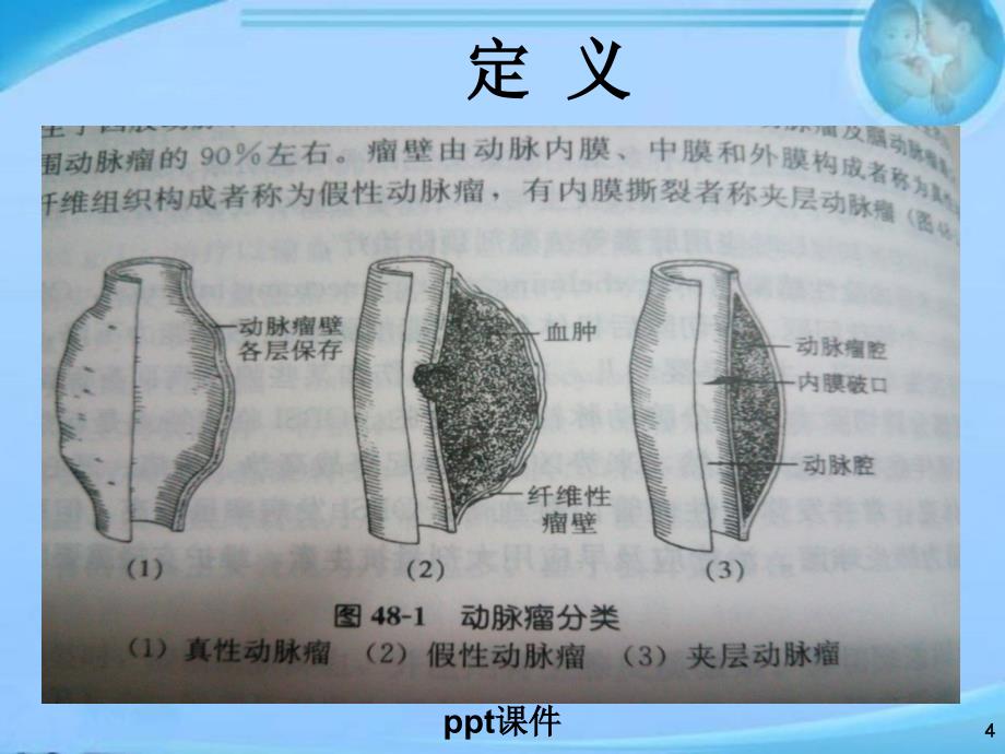 假性动脉瘤ppt课件_第4页