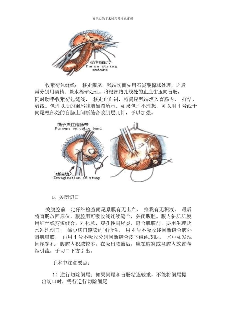 阑尾炎的手术过程及注意事项_第5页