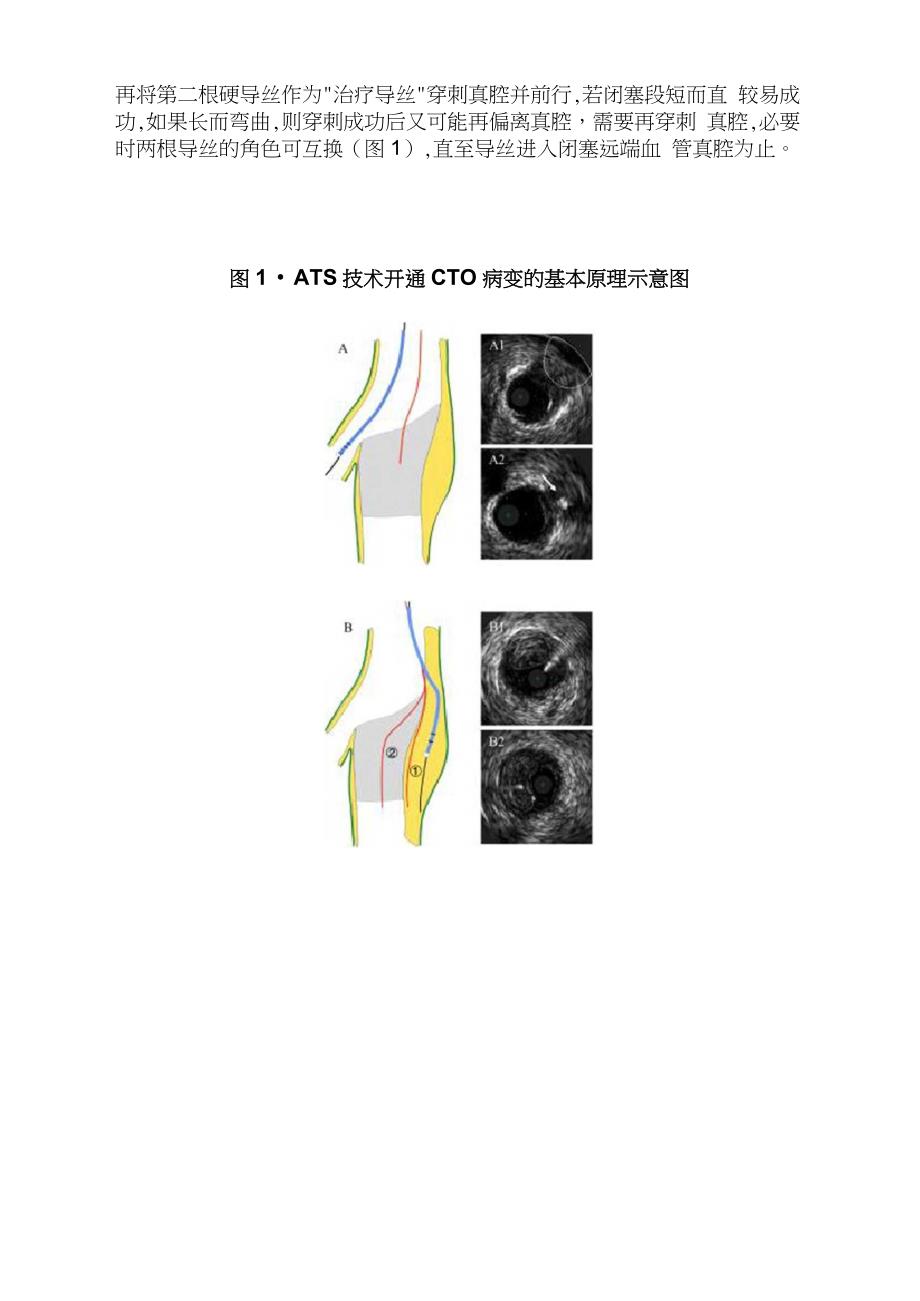 IVUS指导主动真腔寻径(ATS)技术开通复杂CTO病变(全文)_第2页