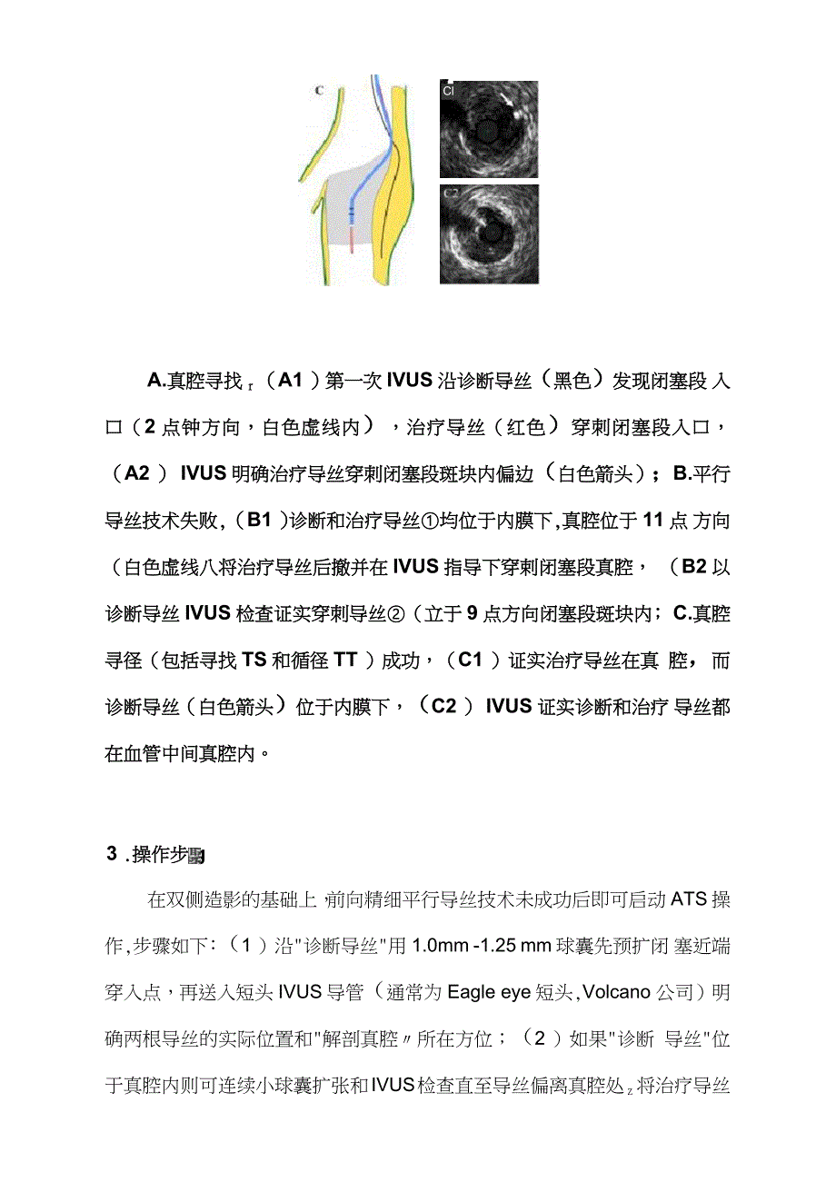 IVUS指导主动真腔寻径(ATS)技术开通复杂CTO病变(全文)_第3页