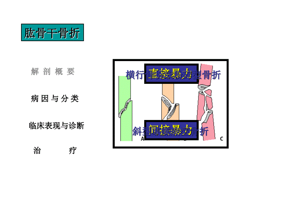 肱骨干骨折治疗_第3页