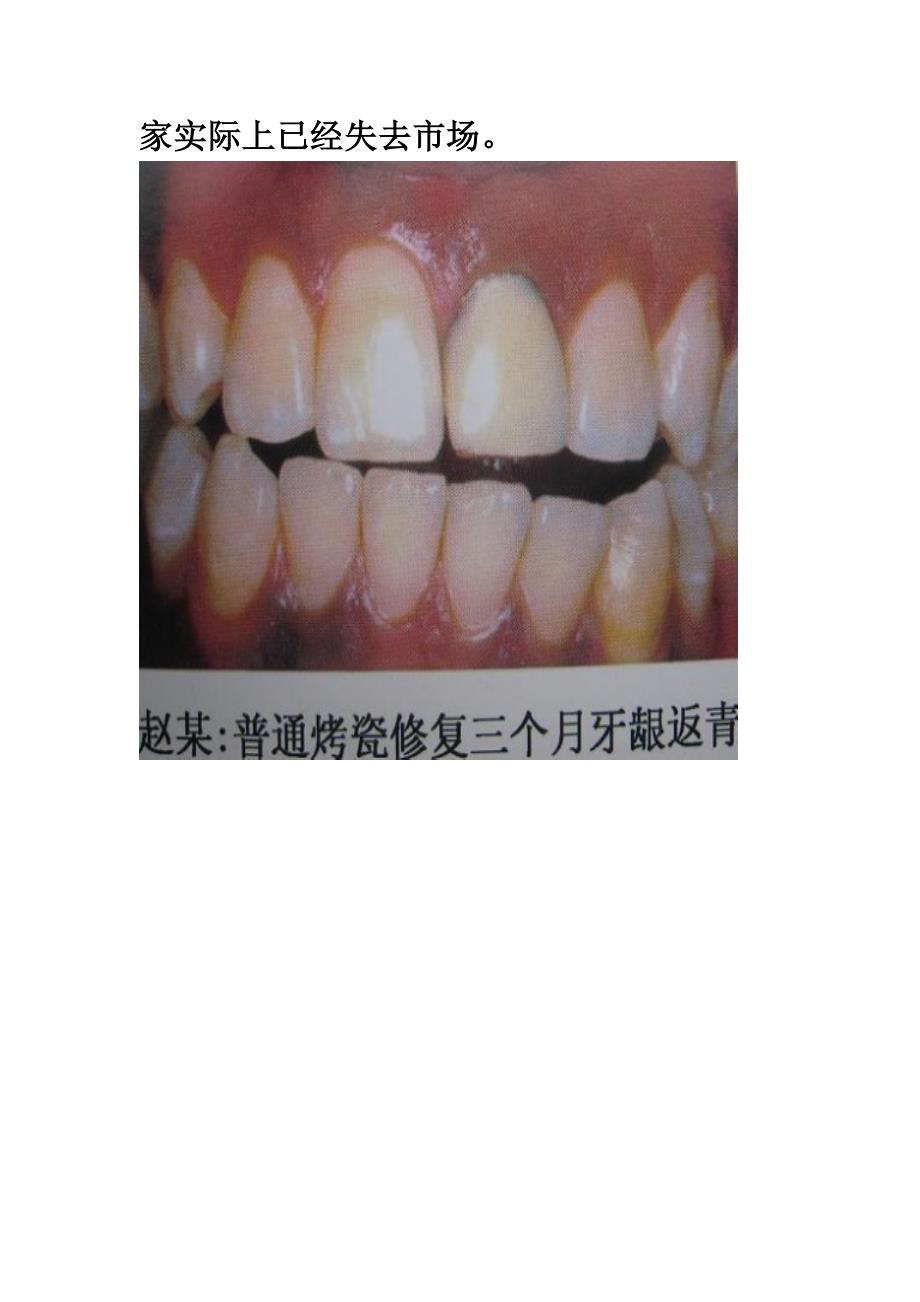 镍铬烤瓷、钴铬烤瓷、贵金属烤瓷_第3页