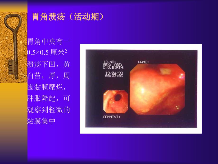 消化性溃疡详解含图课件_第1页