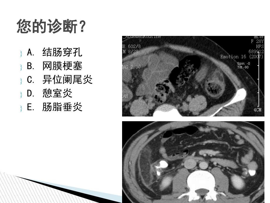 腹腔炎性脂肪性肿块的鉴别诊断_第3页