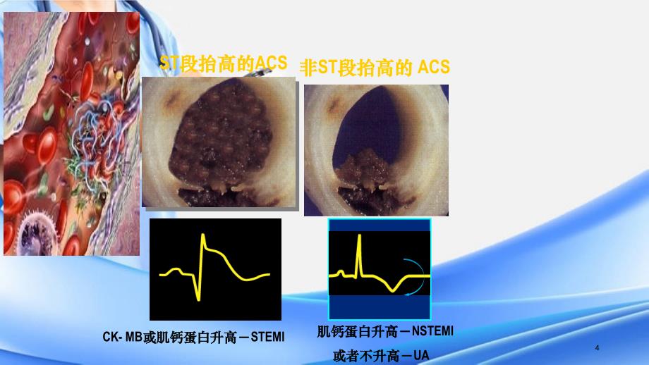 急性冠脉综合征的护理1精选干货_第4页