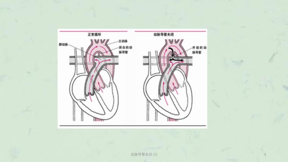 动脉导管未闭2课件_第4页