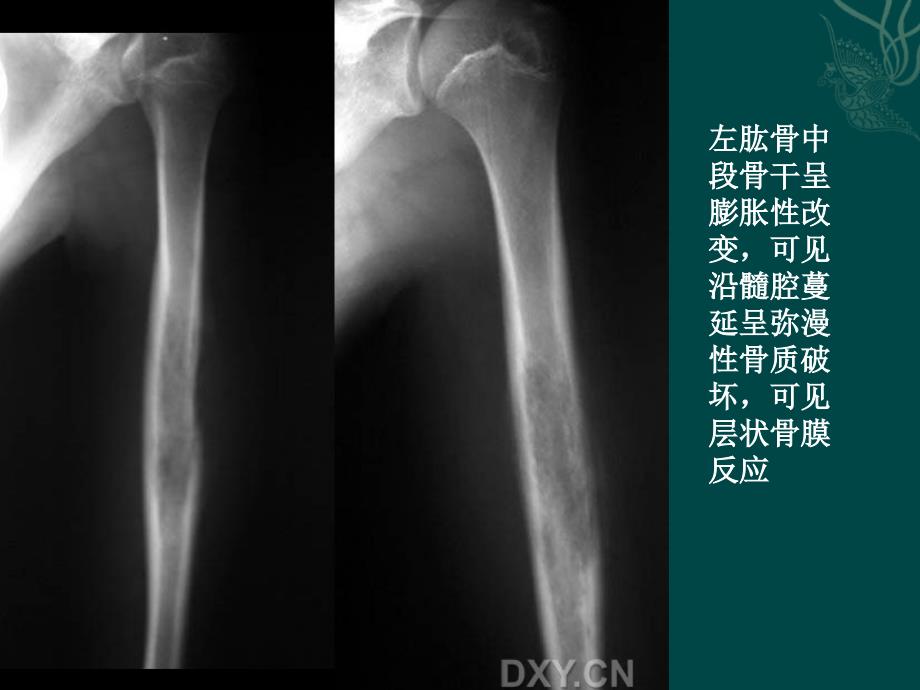 尤文氏肉瘤ppt课件_第2页