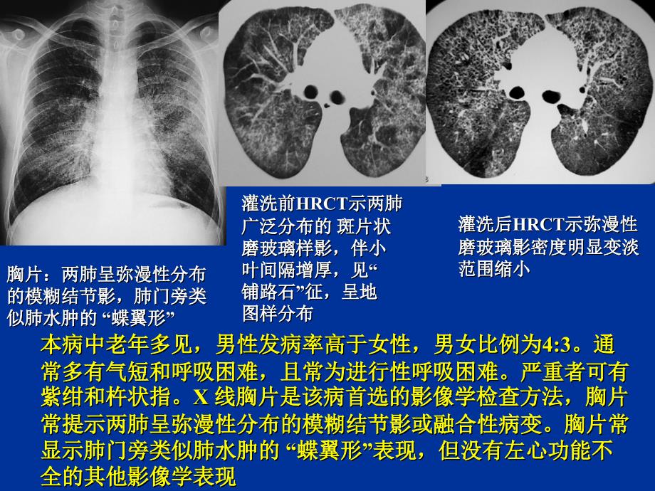 肺泡微结石症PAP_第4页