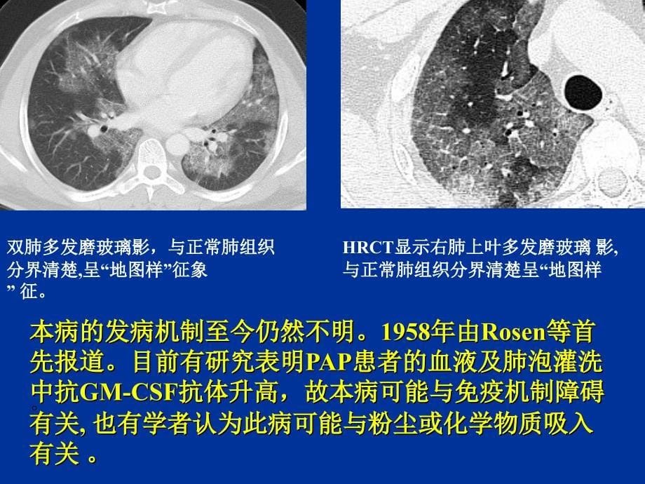 肺泡微结石症PAP_第5页