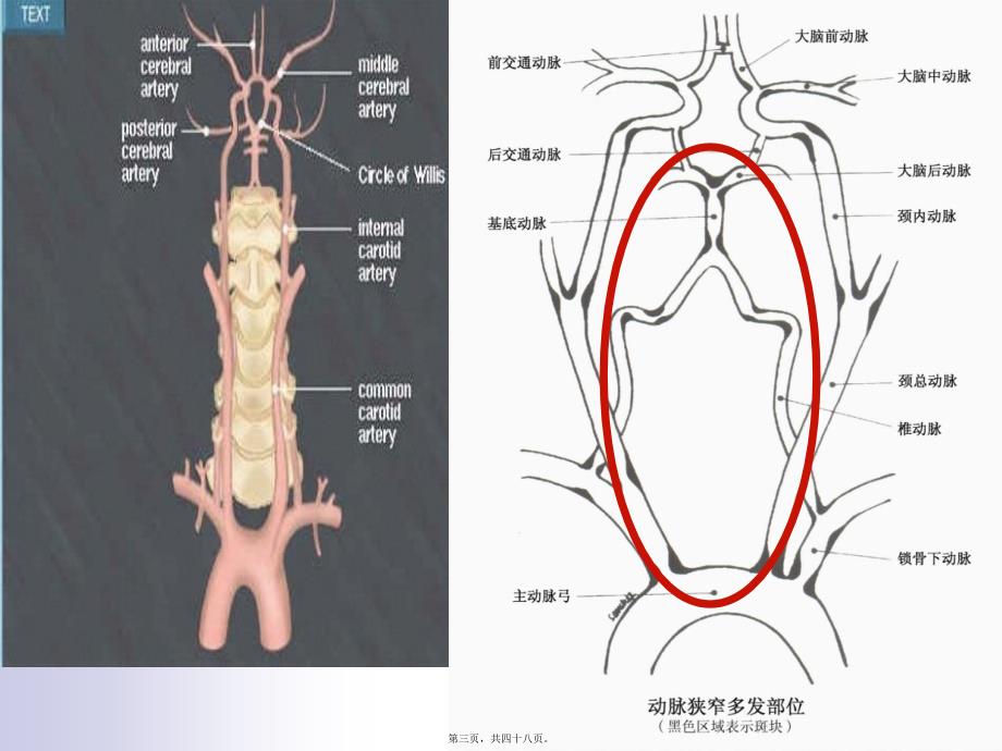 医学专题—眩晕与后循环缺血分析_第3页