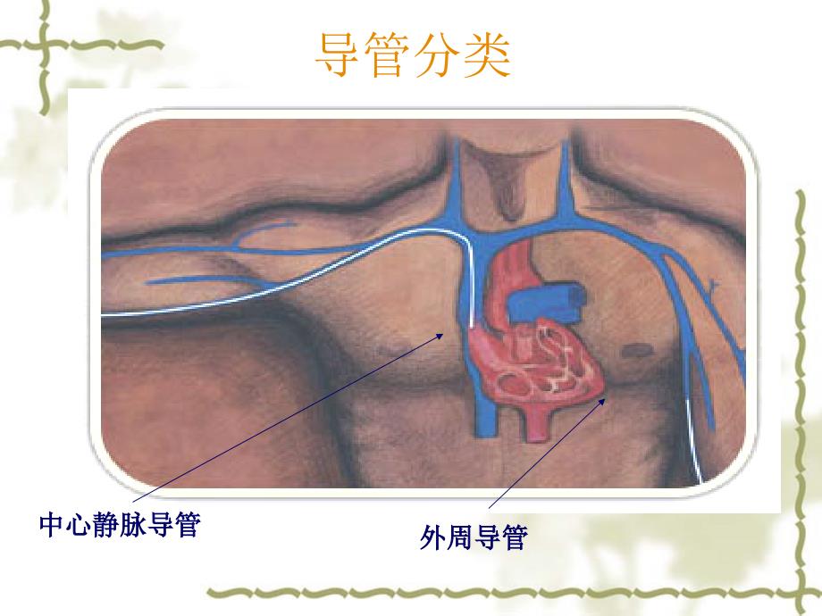 静脉输液工具的选择及维护ppt课件_第3页