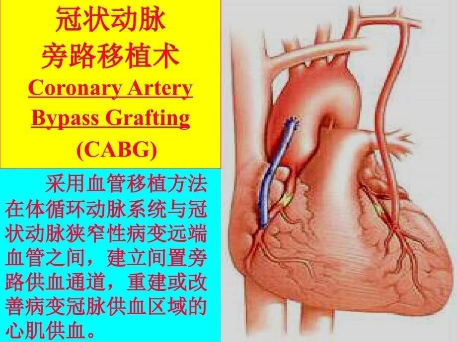 冠心病—外科治疗会议课件文档资料_第5页