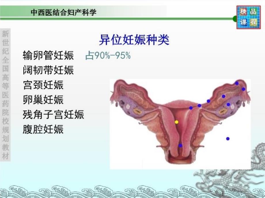 最新异位妊娠熊薇修改后PPT课件_第4页