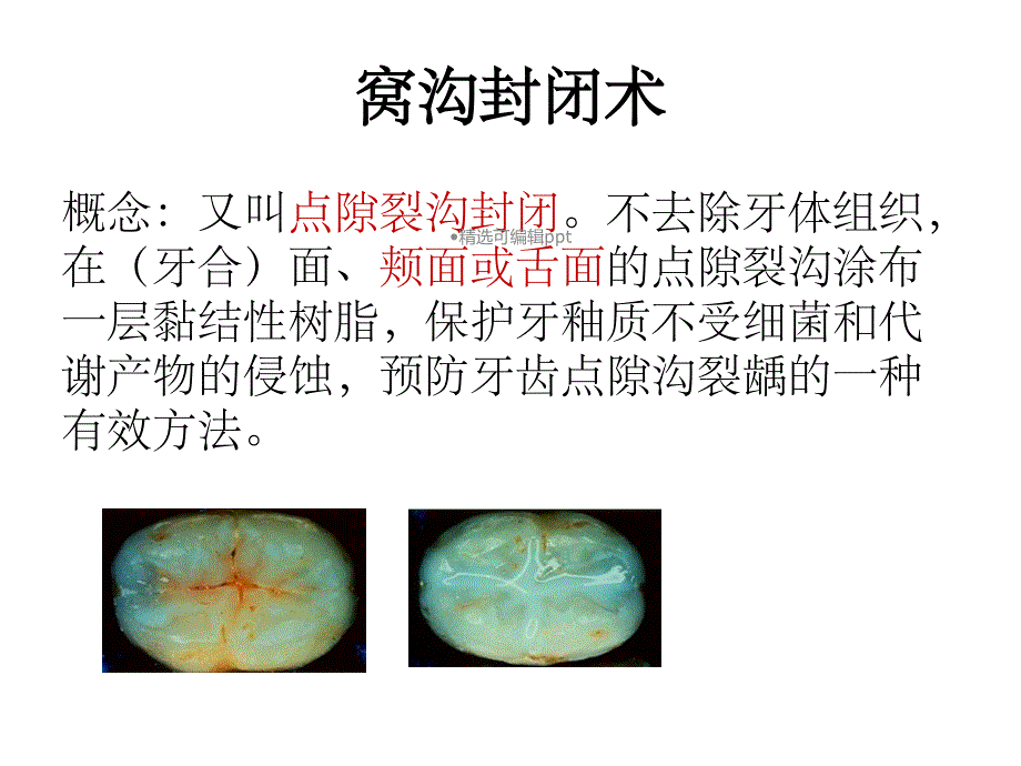 窝沟封闭和涂氟课件_第2页