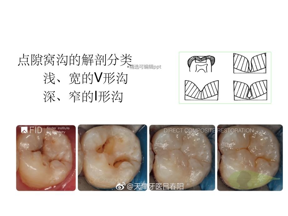 窝沟封闭和涂氟课件_第4页