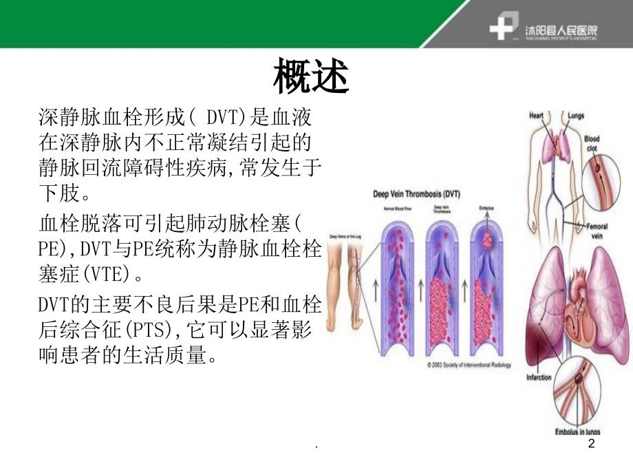 深静脉血栓形成的诊断与治疗指南PPT课件_第2页