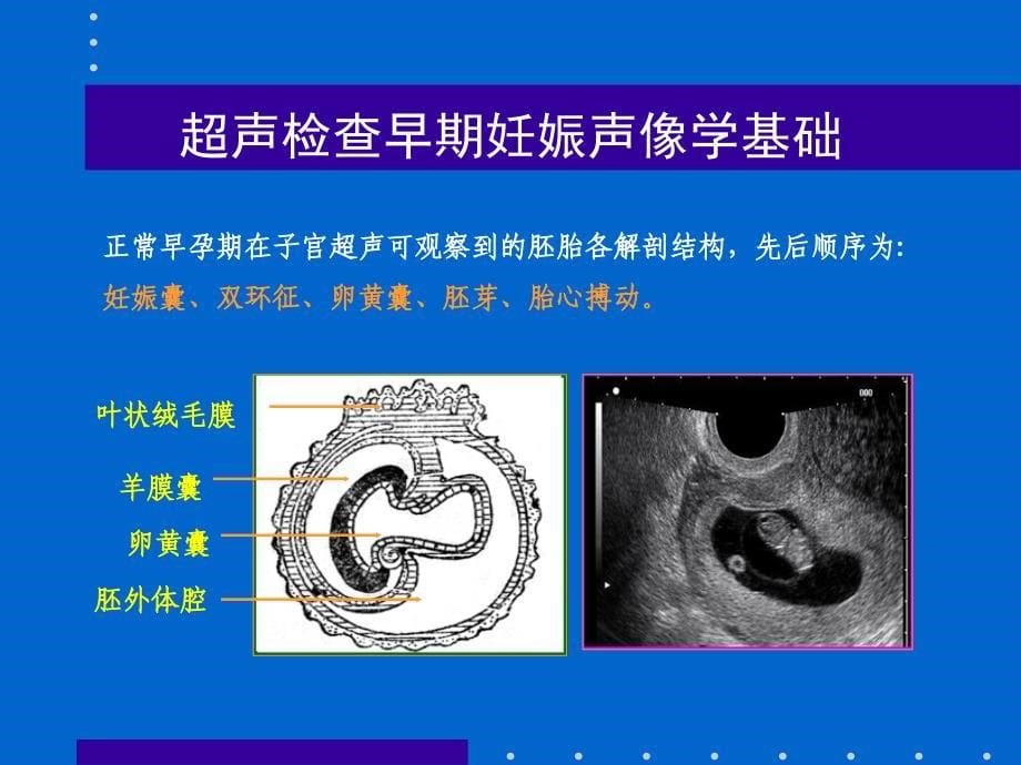 异位妊娠的超声诊断.ppt_第5页