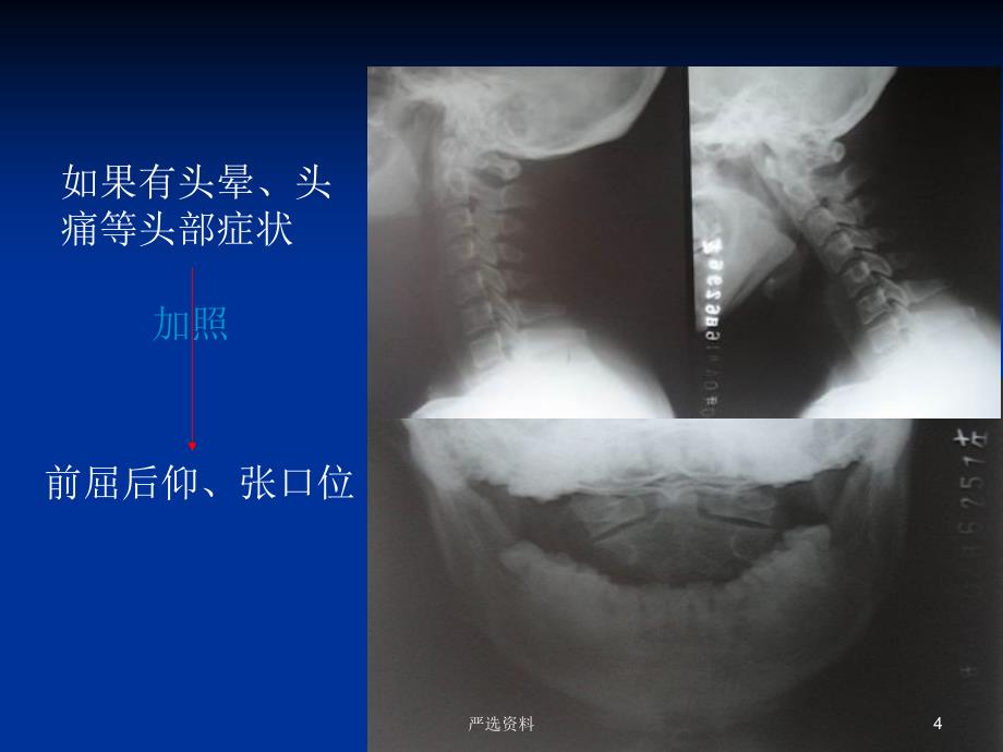 颈椎X光片阅读（行业荟萃）_第4页