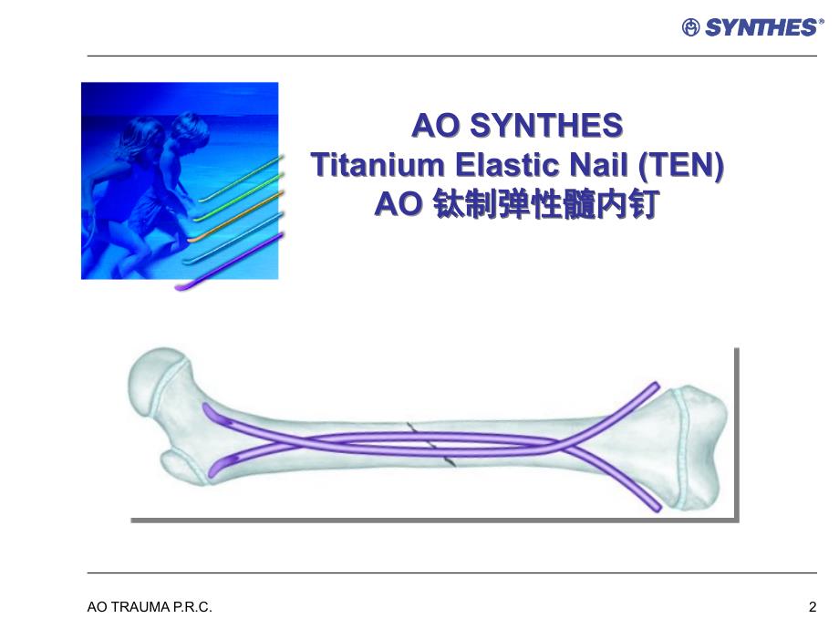 弹力钉的应用ppt课件_第2页