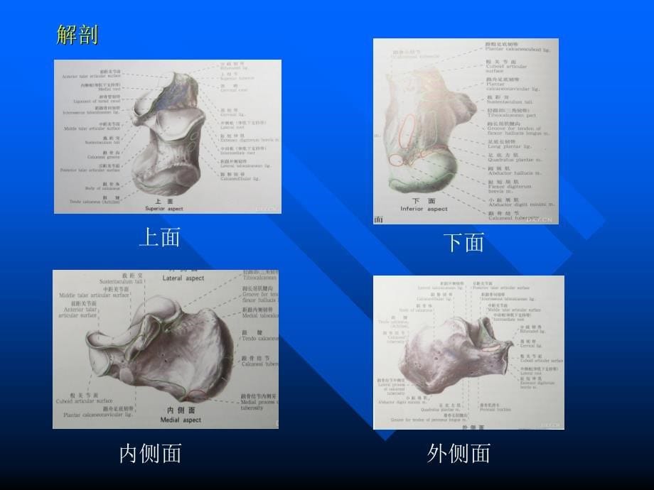 跟骨骨折ppt课件_第5页