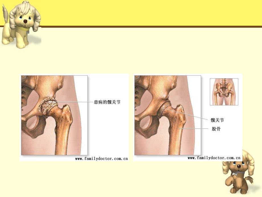 人工全髋关节置换_第3页