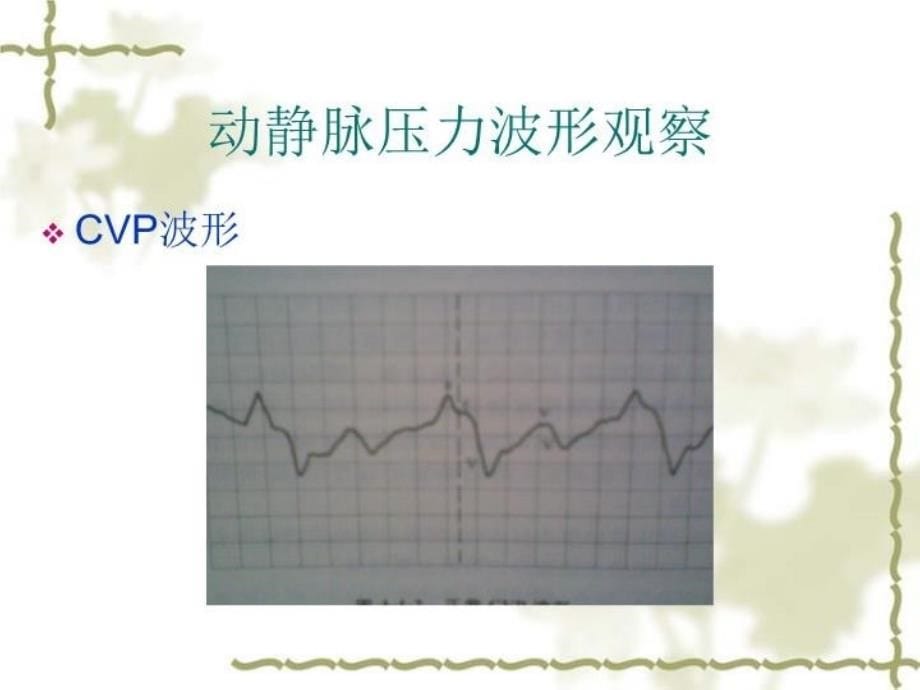 ART及CVP的监测资料_第5页