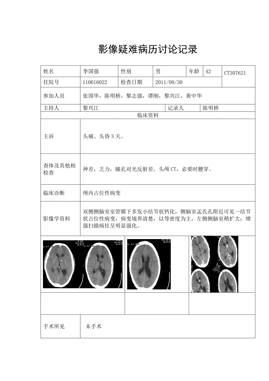 左侧脑室胶质瘤.doc_第1页