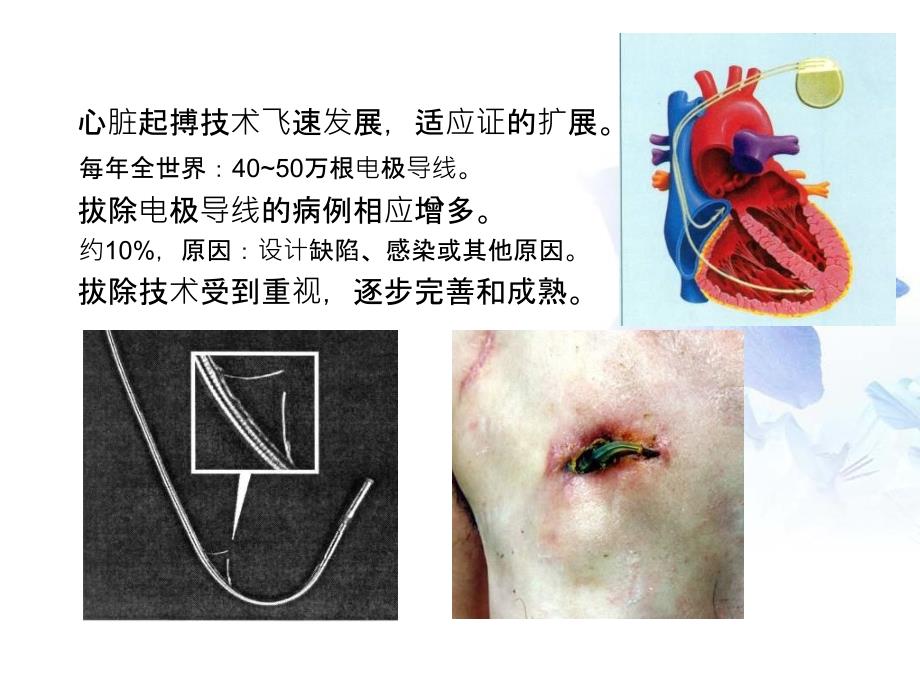 应用血管内反推力牵引技术拔除35根永久起搏电极导线_第3页