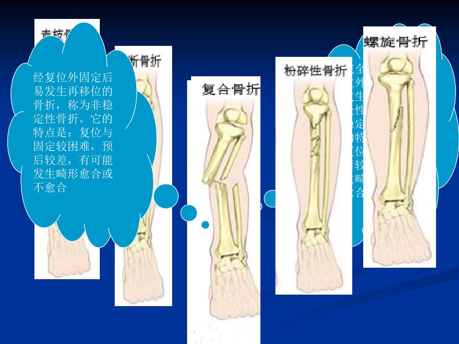 精彩骨折的康复课件_第4页