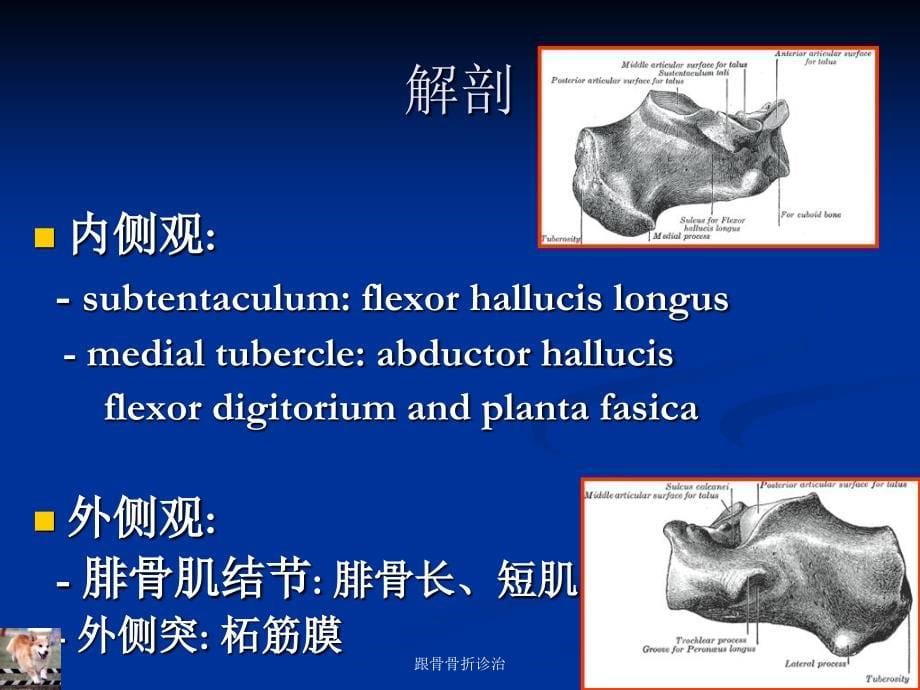 跟骨骨折诊治课件_第5页