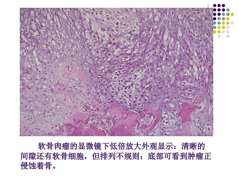 软骨肉瘤的病理及影像学表现_第3页