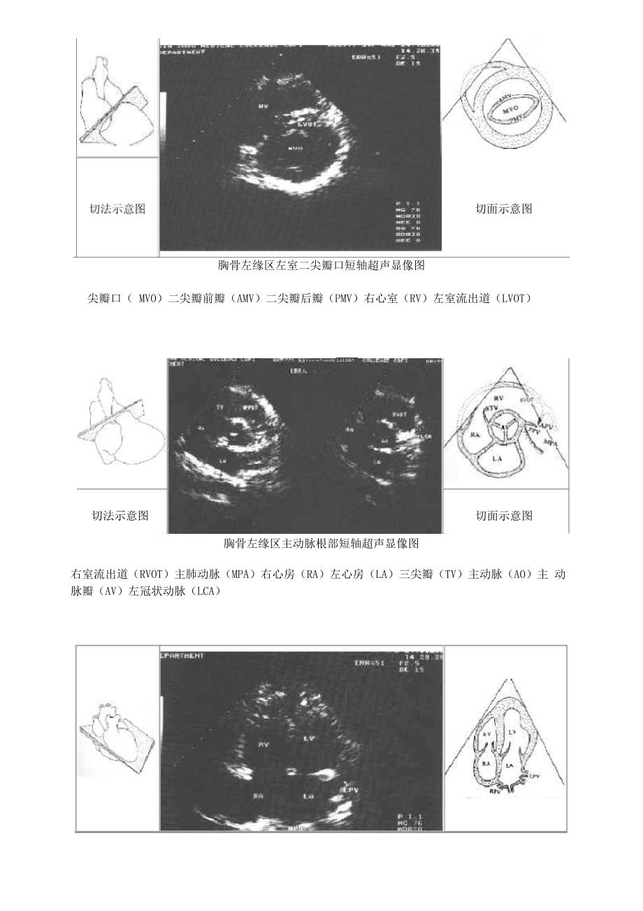 正常心脏B超解剖_第3页