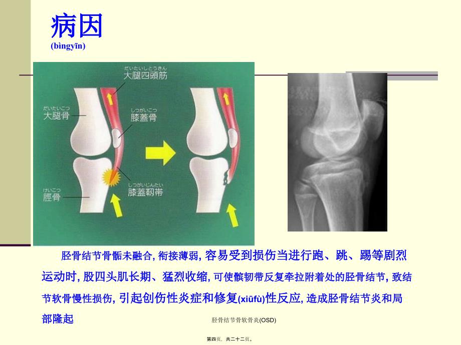 胫骨结节骨软骨炎OSD课件_第4页