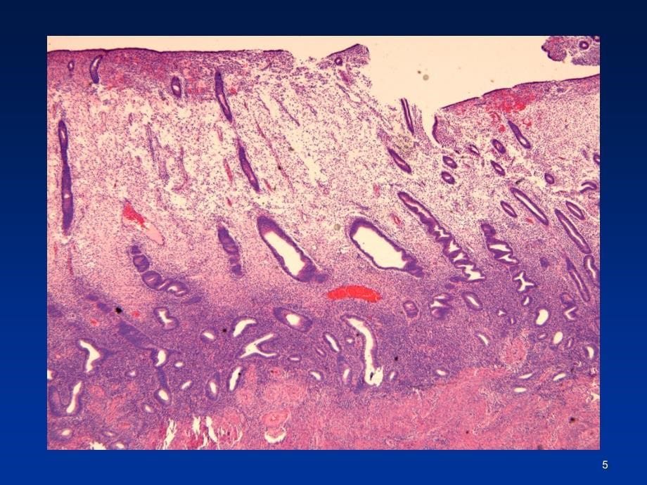 子宫内膜活检病理课件_第5页
