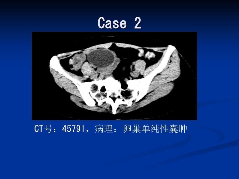 卵巢囊性病变的CT表现_第5页