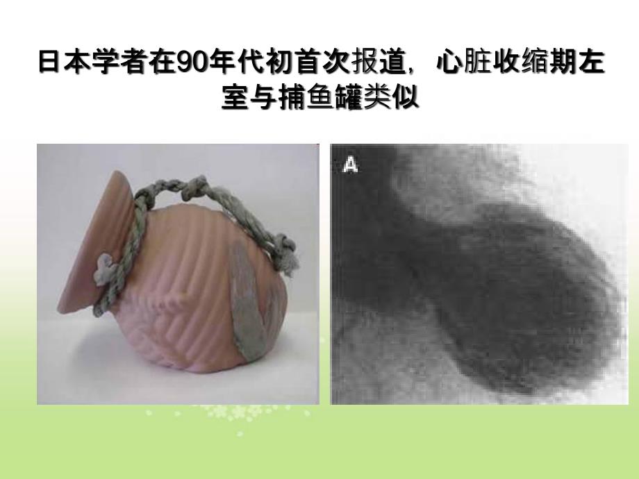 应激性心肌病与心衰的关系_第3页