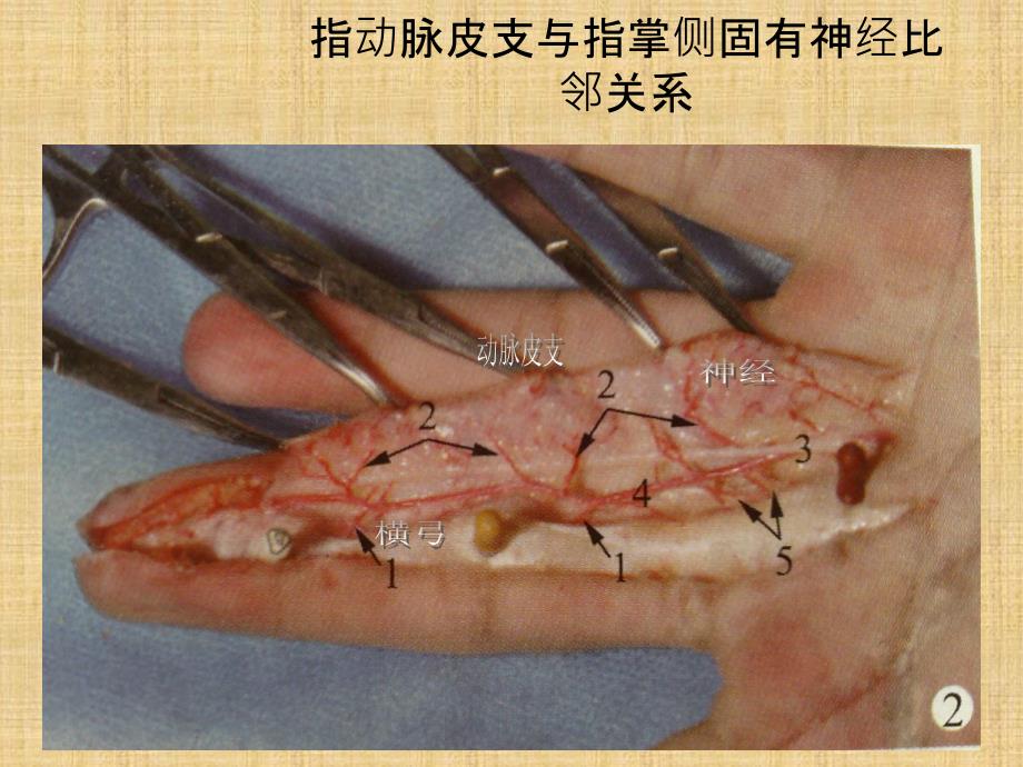 指动脉皮支与指掌侧固有神经比邻关系及其临床意义_第3页